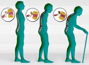 Лечение остеопороза в минске